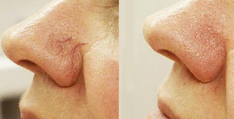  Склерозирование сосудов носа 