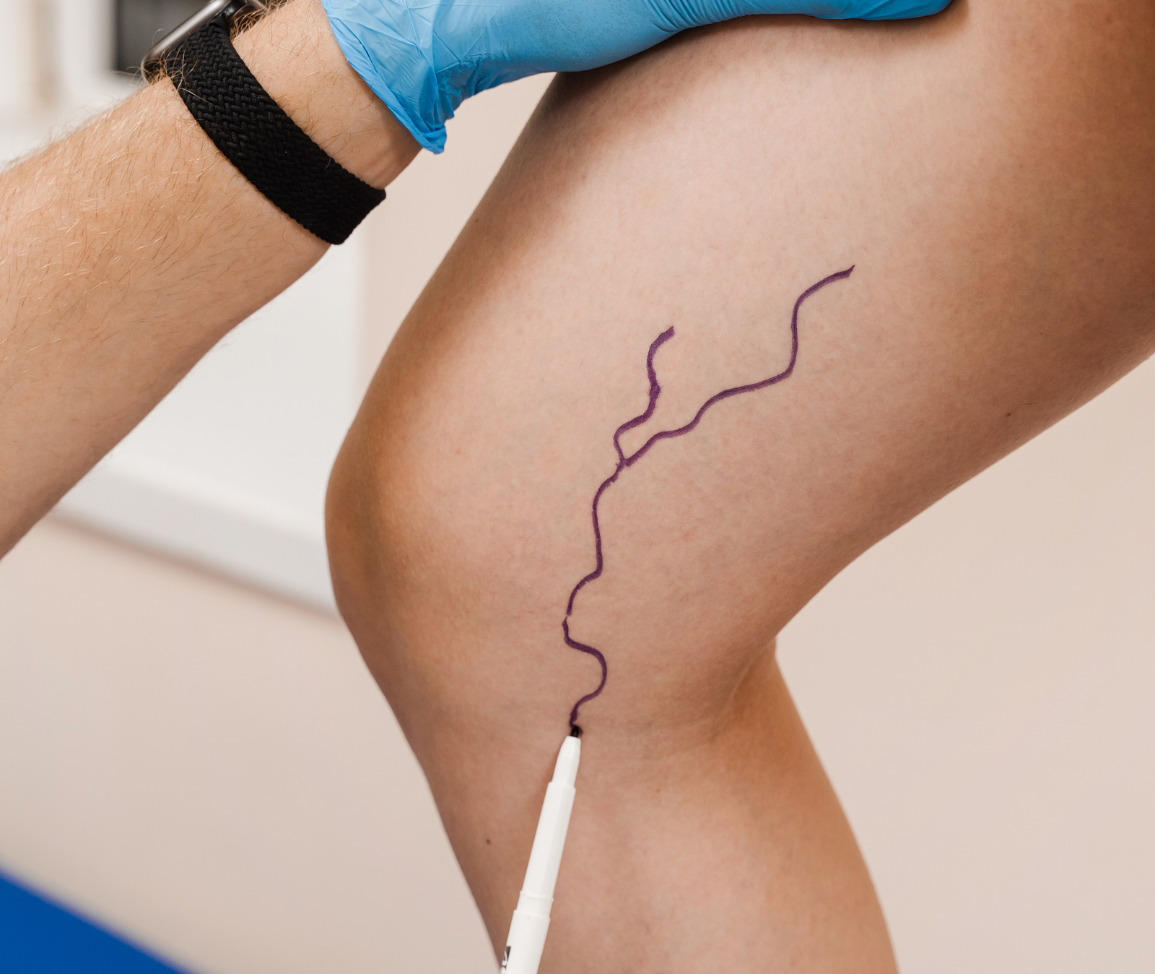 Склерозирование сосудов лазером