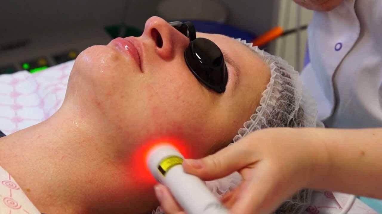 Лазерная биоревитализация кожи лица 